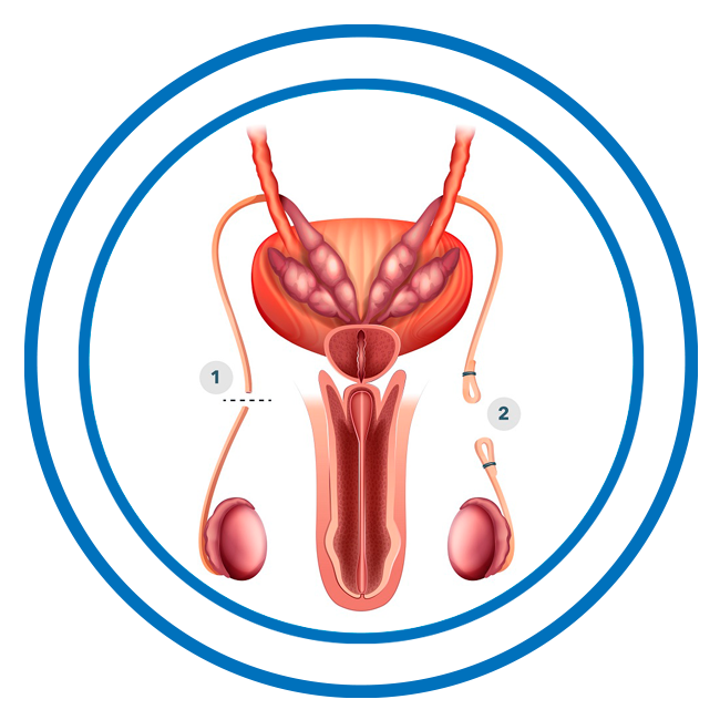 Vasectomía Weburologia En Benidorm Alicante España 3438